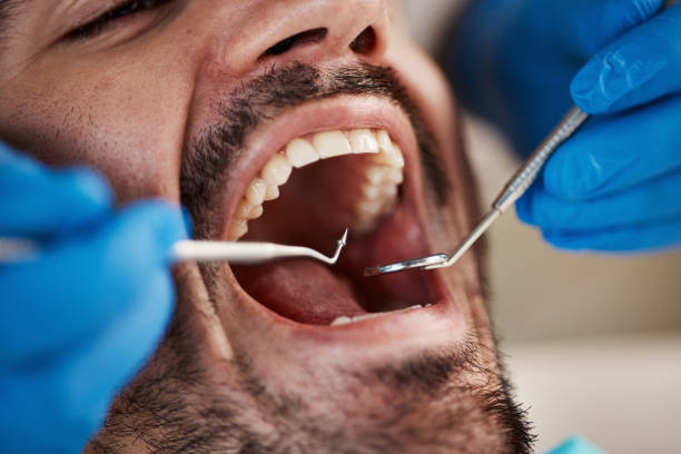 Best Emergency Dental Care for Broken or Chipped Teeth in Upper Brookville, NY